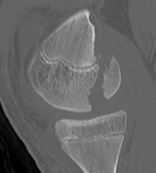 Medial Hoffa CT 1